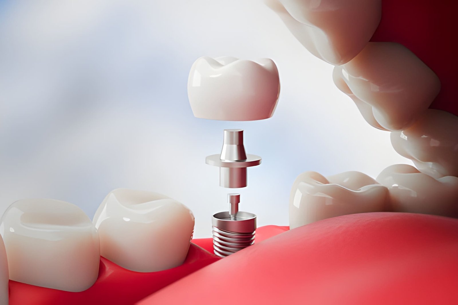 Best Dental Implant Clinic near Kalpataru Parkcity Thane West